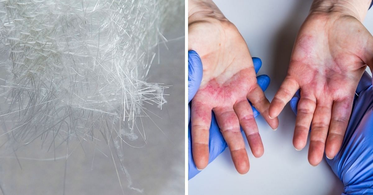 Removing fiberglass from skin (Image via YouTube)